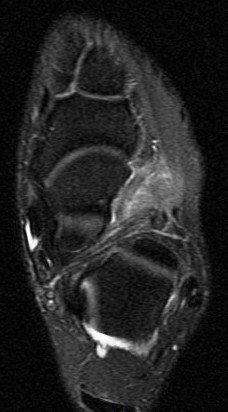Figure 3 for case Sinus tarsi ligament sprains